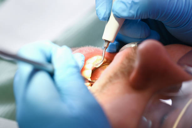 Best Emergency Root Canal Therapy in St Francis, KS
